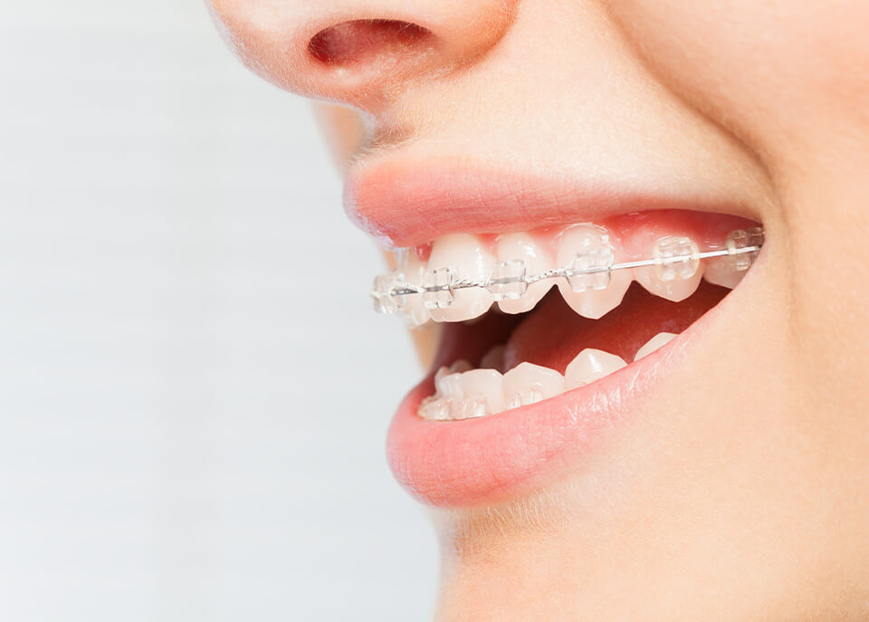 closeup of a smile with braces